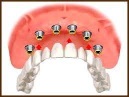 implant-3