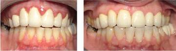 periodontal-tedavi